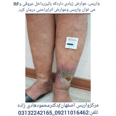 اقدامات لازم درپیشگیری ودرمان واریس. لیزر واریس پا در اصفهان.