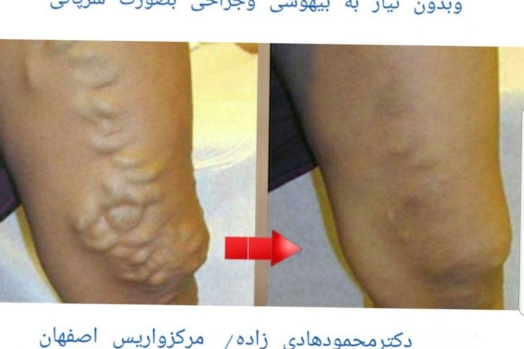 بهترین متخصص واریس شهرکرد