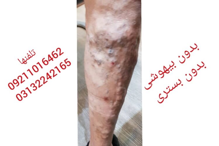 بیماریهای عروقی وریدی ودرمان آنها